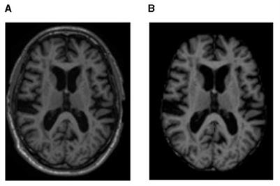 A diagnosis model for brain atrophy using deep learning and MRI of type 2 diabetes mellitus